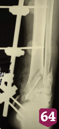  В Саратовской области культиватор раздробил пьяному мужчине ногу